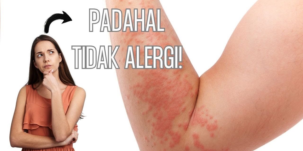 Sinyal Alergi Yang Sering Diabaikan: Bersin, Gatal, Hingga Bentol