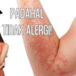 Sinyal Alergi Yang Sering Diabaikan: Bersin, Gatal, Hingga Bentol