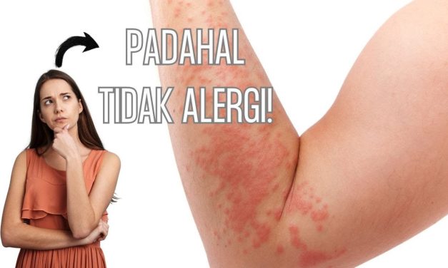 Sinyal Alergi Yang Sering Diabaikan: Bersin, Gatal, Hingga Bentol