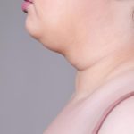 Double Chin Bikin Sebal Karena Mengganggu Penampilan