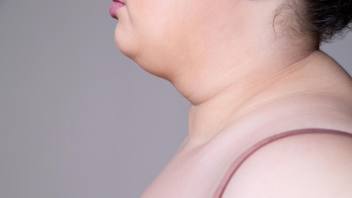 Double Chin
